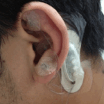 A Pstim ear implant